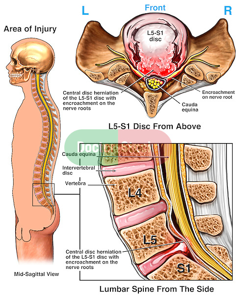 Low Back Pain - Massive L5-S1 Lumbar Disc Herniation with Spinal Nerve Root Impingement.
