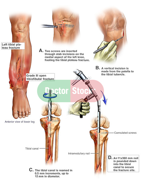 Left Tibial and Fibular Fractures with Surgical Placement of an Intramedullary Rod and Screws.