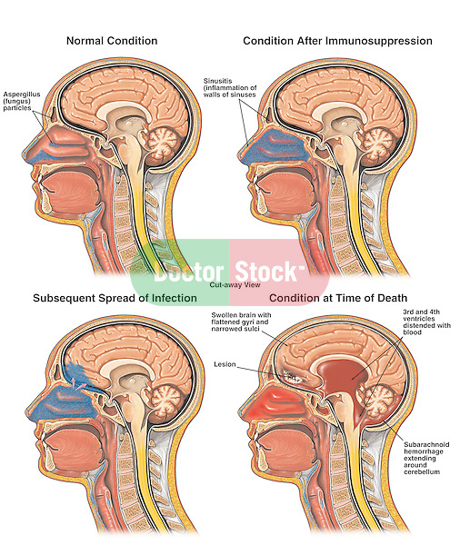This medical exhibit shows four cut-away views of the head and brain illustrating the progression of a sinus infection into the brain. ..The images include, normal anatomy, onset of infection to the frontal sinuses, penetration of the infection through the thin bone layers of the skull into the brain cavity, and the final spread of infection throughout the cranium resulting in brain edema and hemorrhage. ..