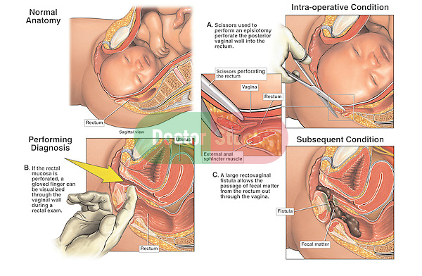 Episotomy Surgery - Iatrogenic (Physician-related) Perforation of the Vaginal Wall with Rectovaginal Fistula.
