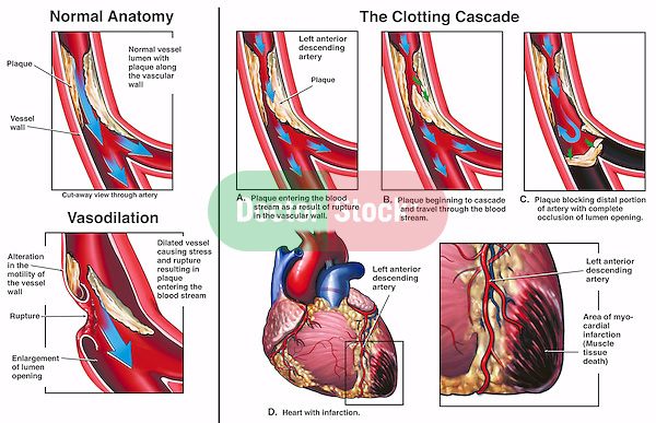 Mechanism of Myocardial Infarction Due to Ruptured Coronary Artery. Shows clot movement within the left anterior descending (LAD) artery resulting in a myocardial infarction, or heart attack. Depicts two plaque-lined coronary arteries, one with a normal vessel lumen, or opening, and one with a greatly thinned out, dilated vessel opening. The latter graphic depicts the dilated blood vessel rupturing, releasing a large amount of plaque into the bloodstream. ..