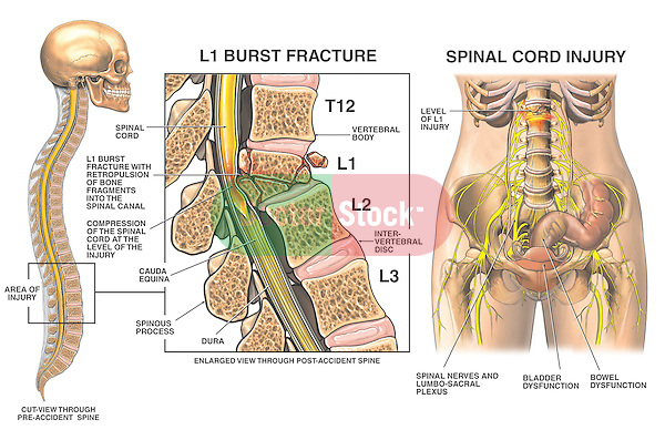 This exhibit features a sagittal (cut-away from side) orientation view of the spine with a detailed enlargement of the L1 region. In the detail we can appreciate an L1 spinal burst fracture with retropulsion of bone fragments posteriorly into the spinal canal and compression of the conus region of the spinal cord. Next to these images appears a single anterior overview of the bones and nerves of the female pelvis illustrating damages to specific nerves secondary to the fractures at L1.