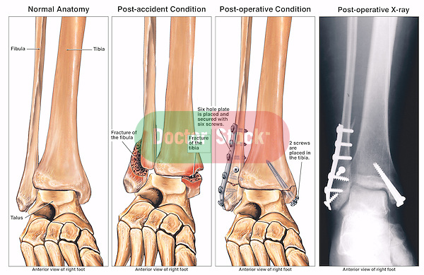 Bimalleolar Fractured Ankle and Subsequent Fixation Surgery with Plates and Screws.
