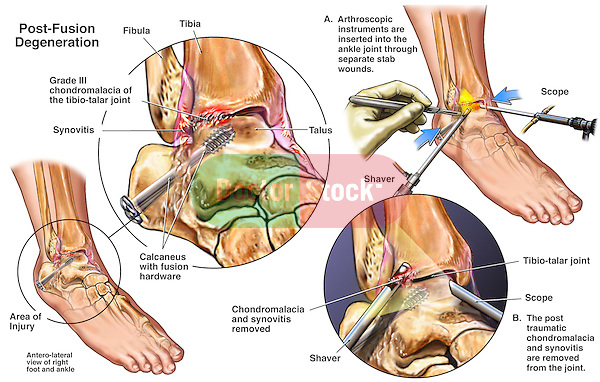 Ankle Joint Arthritis - Arthroscopic Debridement Surgery. This medical exhibit features a surgically fixated ankle joint with resulting chrondromalacia. It illustrates the arthroscopic debridement of the ankle joint.