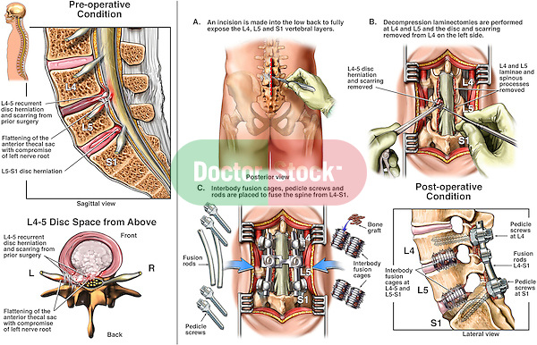 Back Surgery - L4-5 and L5-S1 Laminectomy, Discectomy (Diskectomy) and Spinal Fusion.