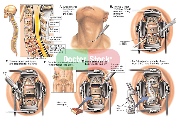 Spine Sugery - C5-6 and C6-7 Disc Herniations with Surgical Discectomy (Diskectomy) and Spinal Fusion. The C5-6 and C6-7 discs are herniated, with the latter showing impingement on the dura and spinal cord. Surgical steps:, A. Neck incision; B. Discectomy at C6-7 with pituitary rongeurs; C. Preparation of vertebral endplates for grafting at C6-7; D. Harvest of bone graft; E. Placement of bone graft at C6-7; F. C5-6 placement of an orion plate and screws.