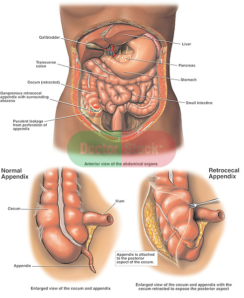 Gangrenous Appendix (Appendicitis) with Perforation and Abscess Formation.