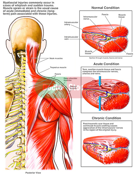 Dramatically depicts acute and chronic myofascial sprain / strain injury. Shows the bones, muscles and fascia of the head, neck and torso, including the trapezius, deltoid and deep shoulder muscles. Displays an acute myofascial condition with torn, swollen muscle tissue and fascia compressing the intramuscular neurovascular elements. The final graphic portrays a chronic condition with post-traumatic scar tissue and muscle swelling causing ongoing aggravation and pain.