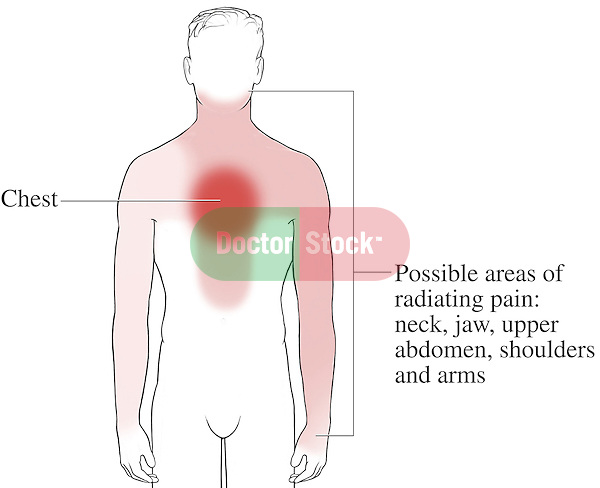 This medical exhibit pictures the most common areas of pain experienced during an attack of angina using an anterior (front) diagram of a male figure with reddened regions representing the painful areas. Labels include a caption reading Possible areas of pain: neck, jaw, upper abdomen, shoulders and arms.