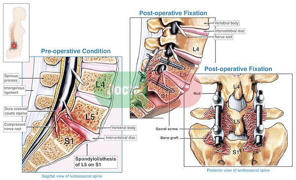 Spinal Fusion Surgery - L5-S1 Spondylolisthesis with Surgical Repair of the Spine.