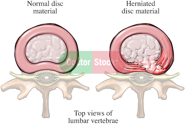 This full color stock illustraton compares a normal lumbar vertebral disc with a right paracentral herniated disc (disk) with nerve root impingement.